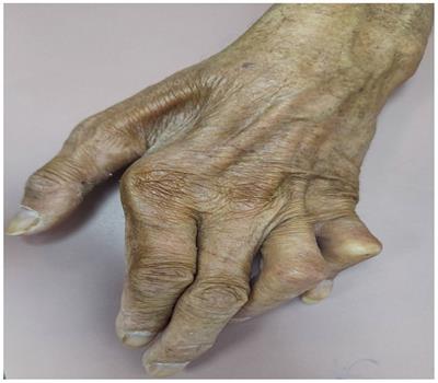 New insights at the interface between leprosy and immune-mediated rheumatic diseases